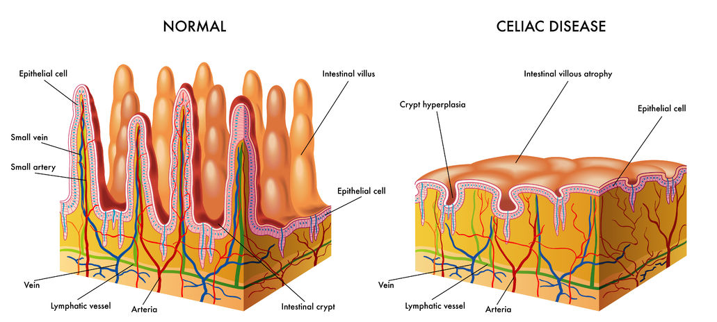 celiac disease test